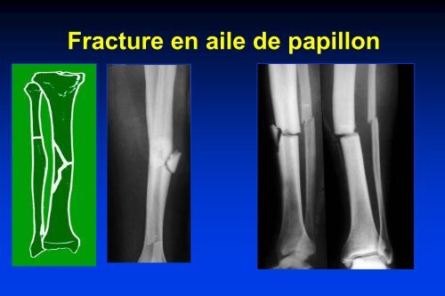 de la fracture - Cours L3 Bichat 2012-2013