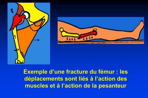 de la fracture - Cours L3 Bichat 2012-2013