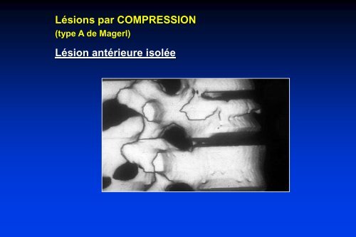 de la fracture - Cours L3 Bichat 2012-2013