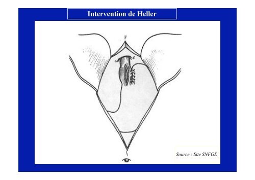 Achalasie de l'oesophage : les traitements - Hepato Web