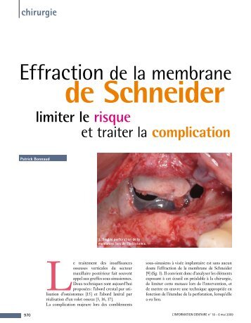 Effraction de la membrane - Information dentaire