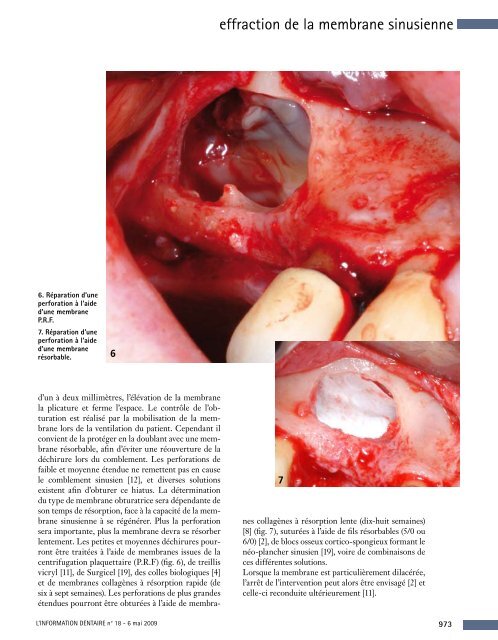 Effraction de la membrane - Information dentaire