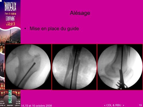 Ostéosynthèse - Enclouage - Euro-Pharmat