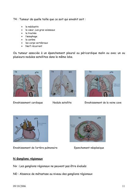 Thésaurus cancer du poumon - GOThA (Groupe d'Oncologie ...