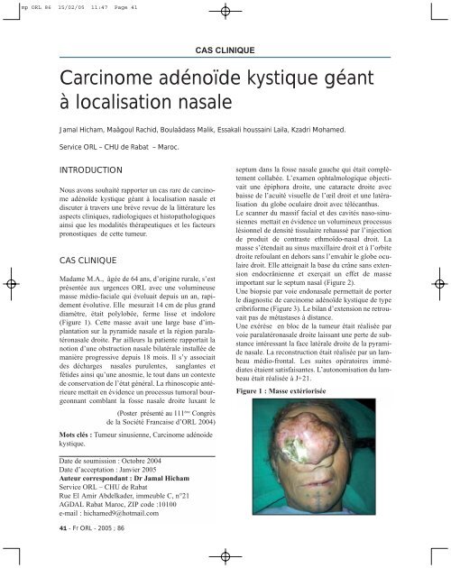 Carcinome adénoïde kystique géant à localisation nasale