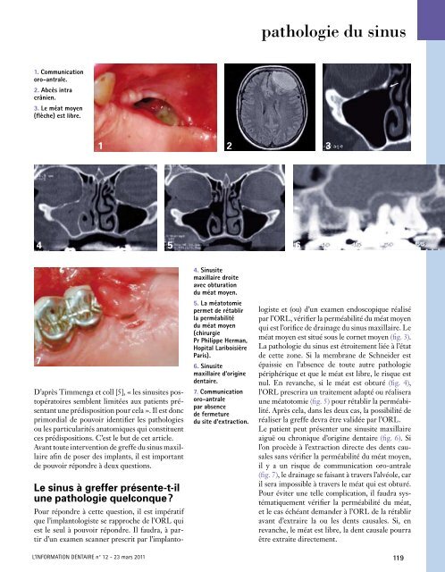 La greffe du sinus maxillaire par approche latérale - Information ...