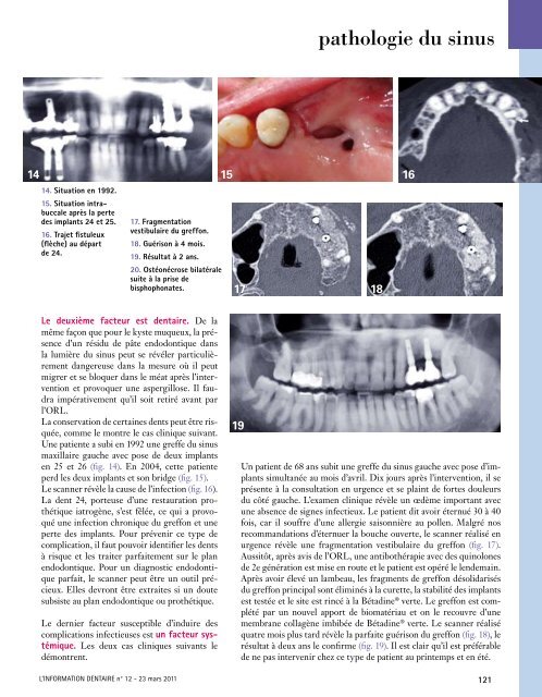 La greffe du sinus maxillaire par approche latérale - Information ...