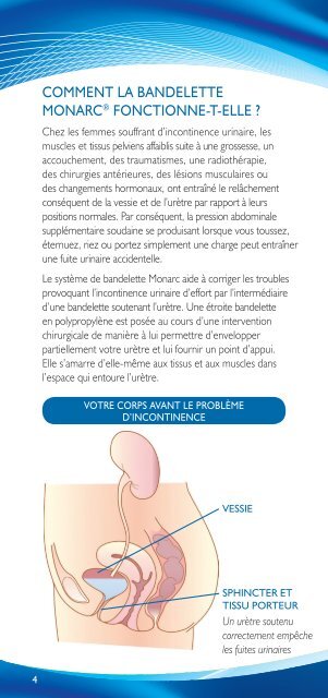 Monarc Patient Brochure