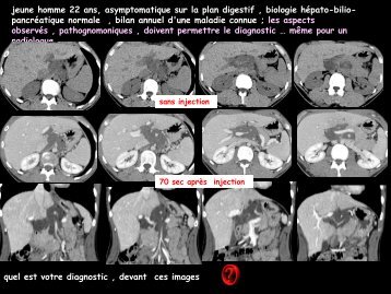 LM CC multiorgane neurofibrome plexiforme periportal