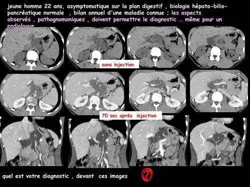 LM CC multiorgane neurofibrome plexiforme periportal