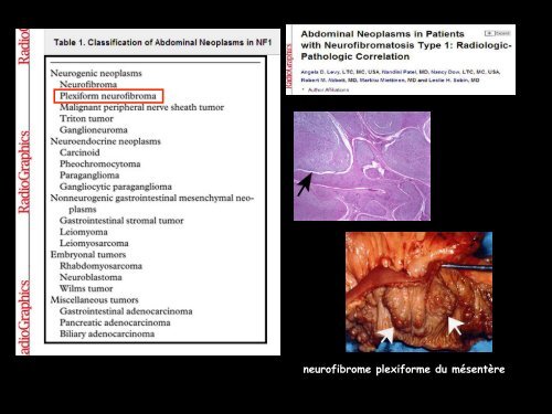 LM CC multiorgane neurofibrome plexiforme periportal