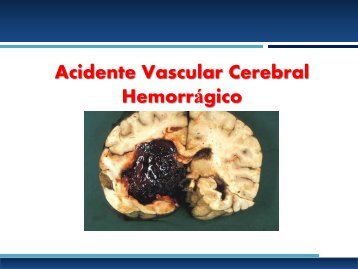 AVC Hemorrágico aula slides