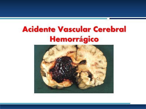 AVC Hemorrágico aula slides