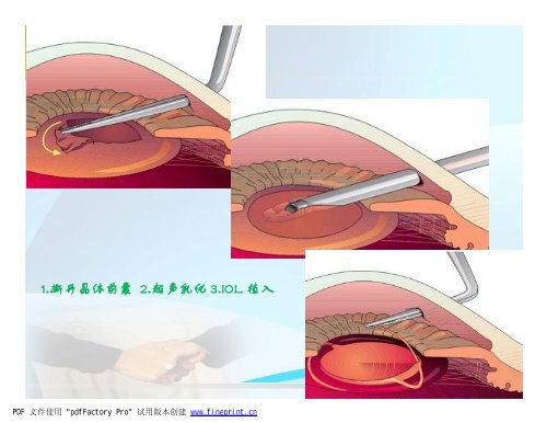 class13 第三章眼科仪器1.ppt [兼容模式]