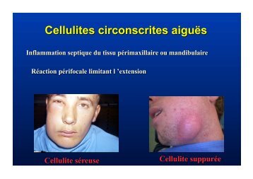 cellulite D2 - copie..