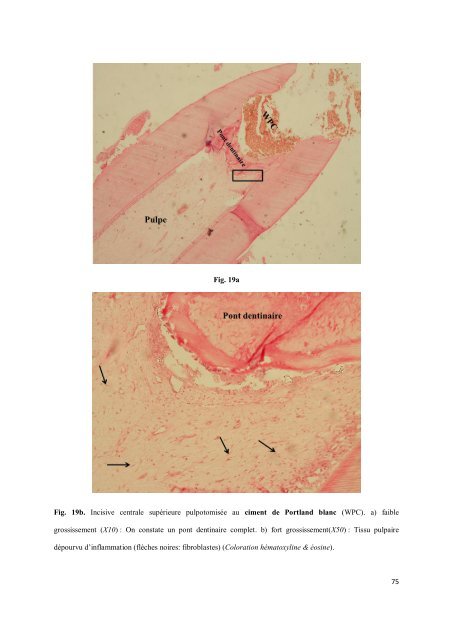 Les matériaux de coiffage et d'obturation pulpaire des dents lactéales