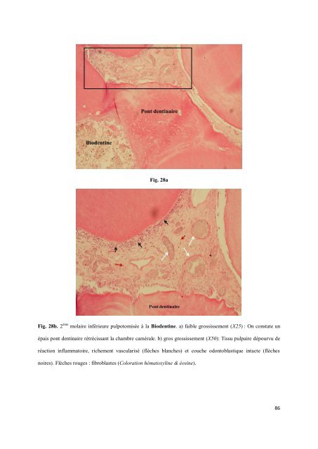 Les matériaux de coiffage et d'obturation pulpaire des dents lactéales