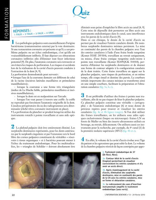 La Cavité d'accès endodontique - Kometdental.de