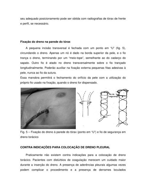 DRENAGEM TORÁCICA Cristiano Feijó Andrade Cirurgião Torácico ...