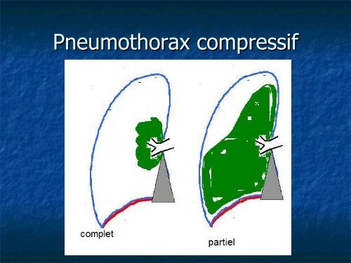 pathologie pleurale.pdf