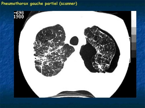 pathologie pleurale.pdf