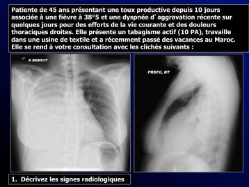 ENC 312 épanchement pleural - RADIOLOGIE BRABOIS