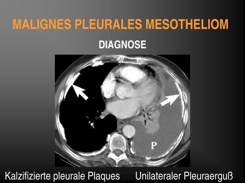 entzündliche und tumoröse erkrankungen der pleura und thoraxwand