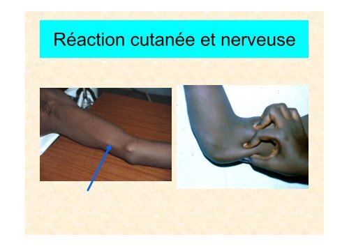 Chirurgie de la lèpre MY.Grauwin