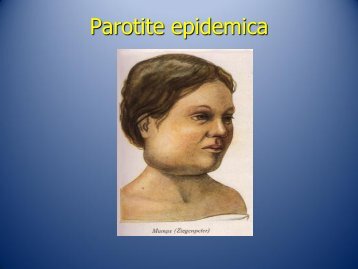 parotite epidemica 2013