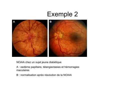 Neuropathies optiques - Pierre Kaminsky