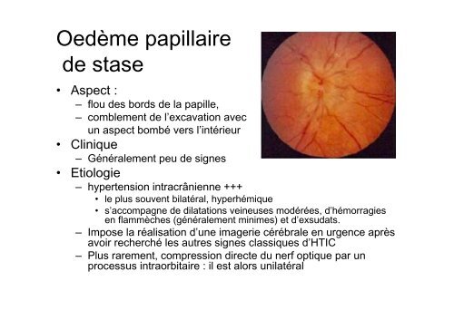 Neuropathies optiques - Pierre Kaminsky