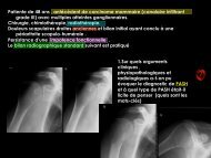 D C lésions focales de l'os généralités o1 - RADIOLOGIE BRABOIS