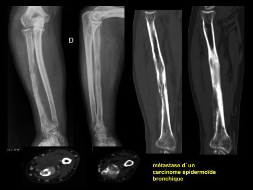 D C lésions focales de l'os généralités o1 - RADIOLOGIE BRABOIS