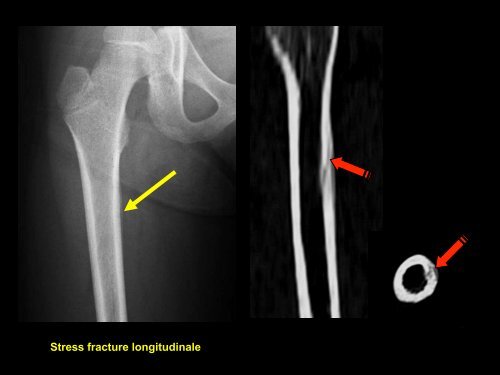 D C lésions focales de l'os généralités o1 - RADIOLOGIE BRABOIS