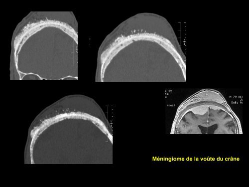 D C lésions focales de l'os généralités o1 - RADIOLOGIE BRABOIS