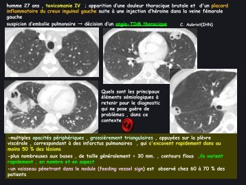 LM CC cardio vasc embolie septique drogué IV - RADIOLOGIE ...