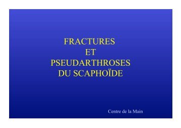 FRACTURES ET PSEUDARTHROSES DU SCAPHOÏDE - Sofcot