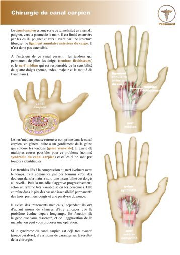 Chirurgie du canal carpien