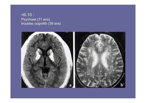 Maladie de Fahr Calcifications des noyaux gris ... - CHU de Rouen