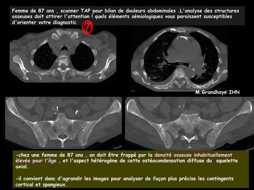 LM CC multiorgane mastocytose ostéo-médullaire - RADIOLOGIE ...