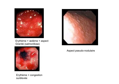 Lésions endoscopiques du tractus digestif ... - Hepato Web