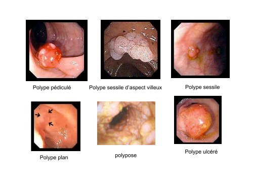 Lésions endoscopiques du tractus digestif ... - Hepato Web