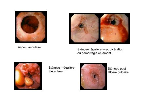 Lésions endoscopiques du tractus digestif ... - Hepato Web