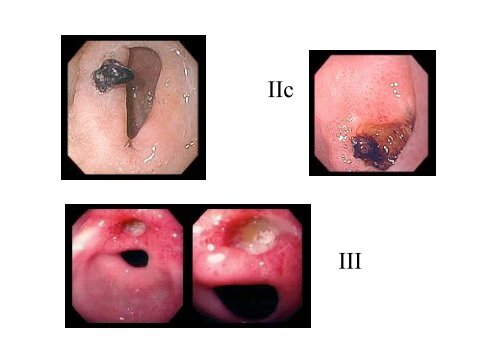 Lésions endoscopiques du tractus digestif ... - Hepato Web