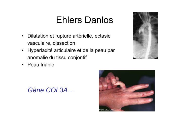 Hyperlaxator Ehlers Danlos • Dilatat