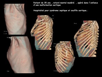 D CC cardio-vascul syndrome de Williams Beuren - RADIOLOGIE ...