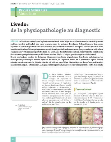 Livedo - Réalités Cardiologiques