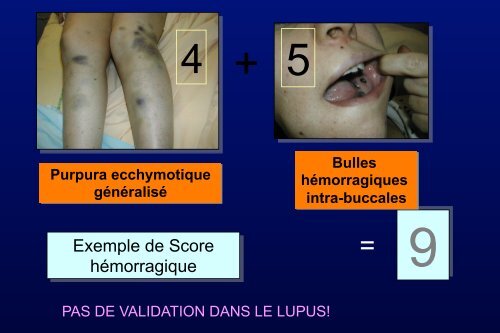 Traitement de la thrombopénie au cours du Lupus