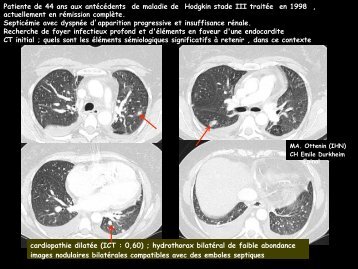 cardiopathie dilatée (ICT : 0,60) ; hydrothorax bilatéral de faible ...