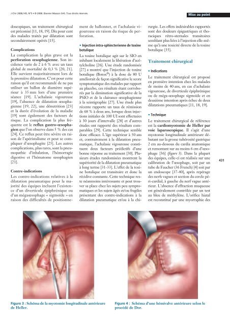 Traitement chirurgical des troubles moteurs de l'œsophage - Espoire